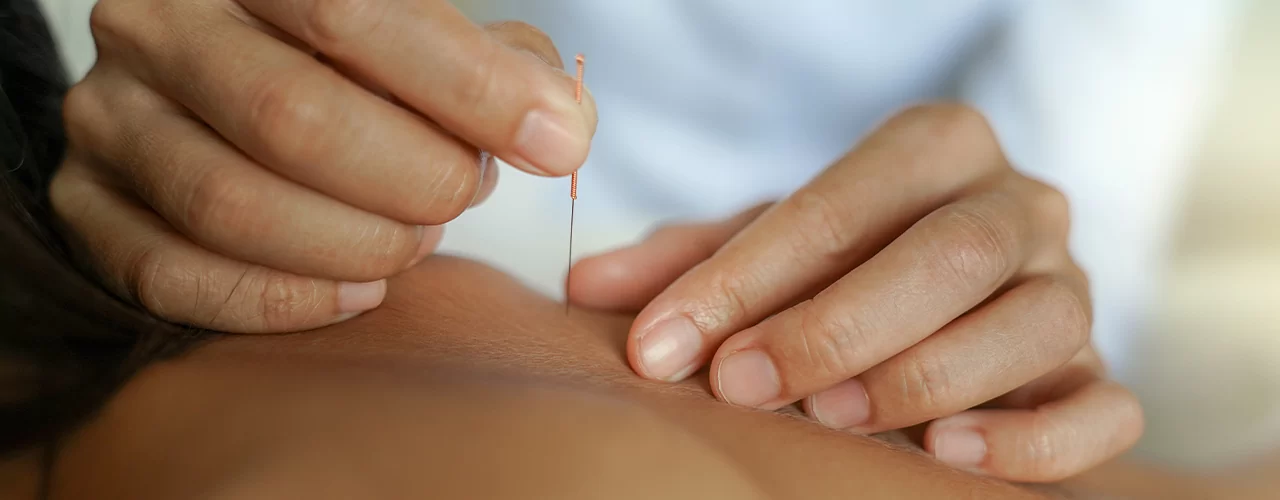 Dry-Needling-Performance-Therapy-Mississippi