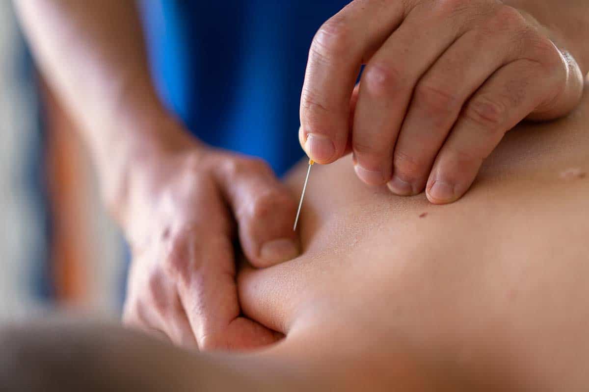 dry-needling-fisioterapia-ilcentro